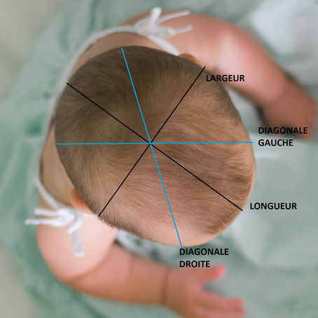 Dépistage gratuit des déformations crâniennes des nourrissons.