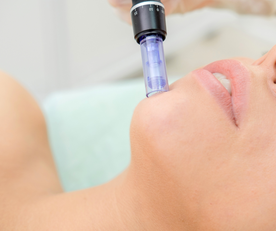 Microneedling Face in West Palm Beach – Facial Skin Rejuvenation