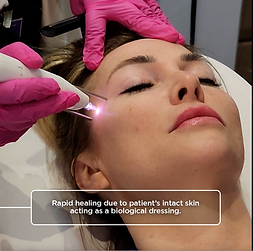 Pure plasma skin treatment West Palm Beach