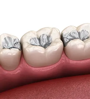 Dental Filings.webp