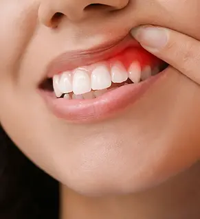 Gum Treatment.webp