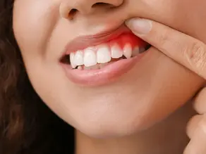 Gum Disease: Causes, Signs, and How to Treat It