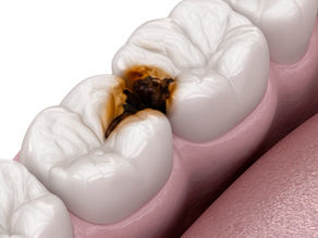 Deep Cavities: Symptoms, Treatment Options & Costs in HK