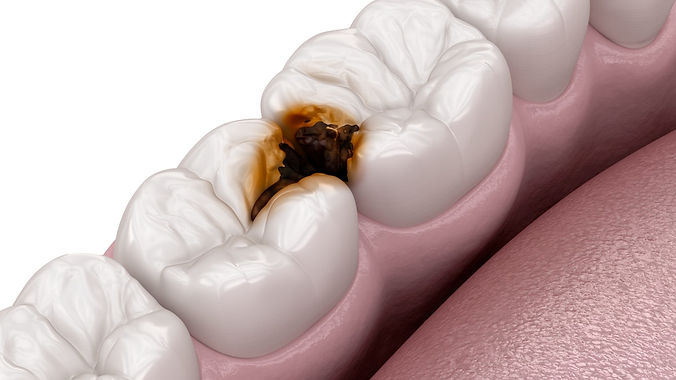 Deep Cavities.jpg