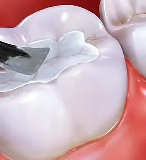 Fissure Sealants.webp