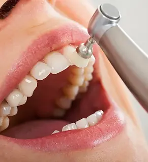 Fluoride Treatment.webp