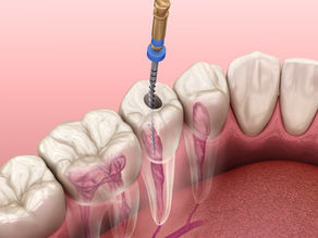 Premolar Root Canal: Procedure, Cost, and Recovery Guide
