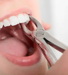 Tooth-Extraction.webp