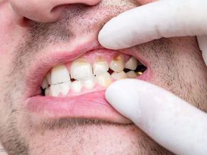 Tooth Decay: Causes, Stages, and How to Treat It