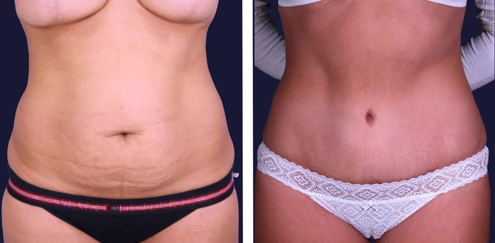 Before and after Mommy Makeover transformations featuring tummy tuck, breast lift, and body contouring results in Turkey and Brazil.