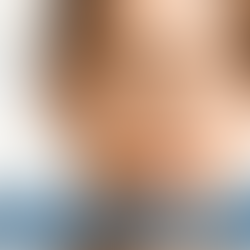 Middle-aged woman with surgical guide lines on face symbolizing common plastic surgeries for women including facelift, deep plane facelift, neck lift, and blepharoplasty