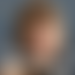 Miley Cyrus showing her Hollywood smile after dental veneers and cosmetic dentistry transformation.