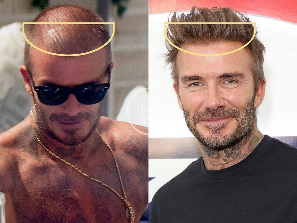 Side-by-side comparison of David Beckham before with thinning hair and after with fuller restored hairline.