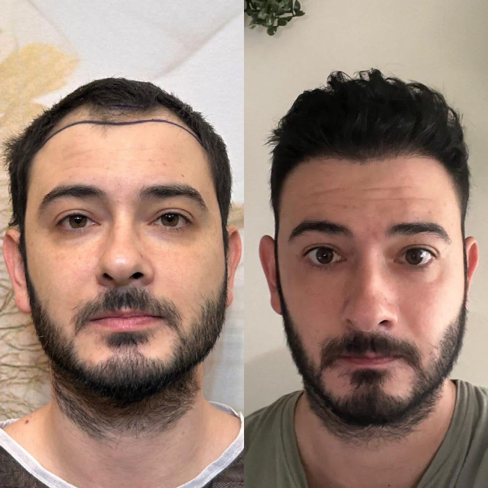 Side-by-side comparison of male hair restoration results after FUE hair transplant.
