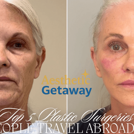 Before and after facelift transformation showing youthful skin restoration