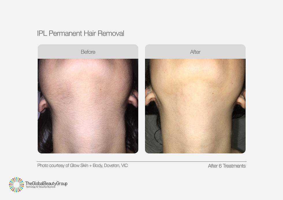 IPLHairRemovalBeforeAfter02