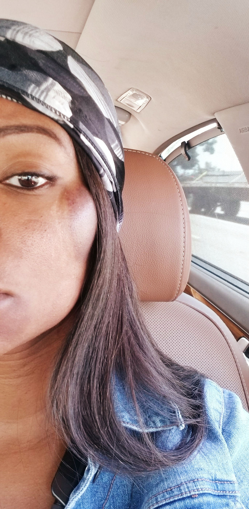 A black woman face is bruised after receiving face cupping service