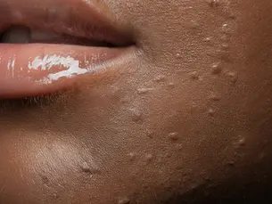 Top 5 Medspa Treatments for Achieving Radiant Glowing Skin
