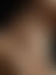 Understanding the Risks and Side Effects of RF Microneedling for Safe Skincare