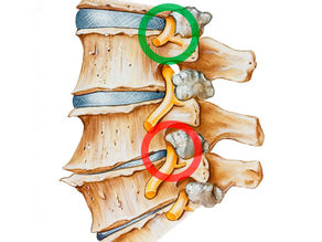 Остеохондроз: причини, симптоми та як допоможе реабілітація в центрі MOVEMENT