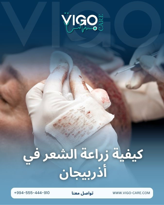 كيفية زراعة الشعر في أذربيجان