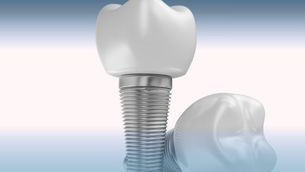 Давайте познакомимся через руководство по имплантации зубов в Азербайджане с важнейшими моментами, которые интересуют пациента относительно имплантации зубов в Азербайджане  Дентальные имплантаты в Азербайджане — ваш первый выбор для начала нового этапа красоты..  Стоимость имплантации зубов в Азербайджане - почему имплантация зубов в Азербайджане - преимущества имплантации зубов в Азербайджане - как проходит имплантация зубов в Азербайджане - вопросы об имплантации зубов в Азербайджане