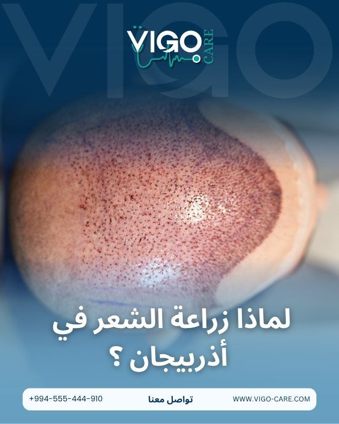 دليل زراعة الشعر في أذربيجان