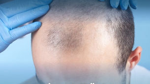 زراعة الشعر في أذربيجان: خطوتك الذكية نحو مظهر طبيعي وثقة متجددة