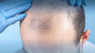 زراعة الشعر في أذربيجان: خطوتك الذكية نحو مظهر طبيعي وثقة متجددة