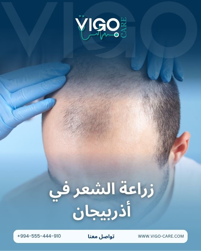 زراعة الشعر في أذربيجان .. سرّك لإظهار الثقة والمظهر الشبابي الطبيعي