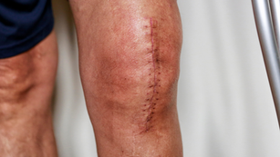 Як доглядати за шрамом, щоб він став непомітним