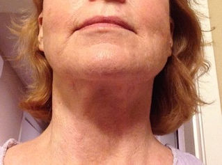 Avoid Facelift With Flexaway