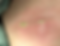 Skin burned by RF.