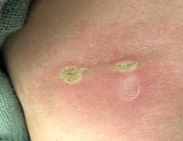 Skin burned by RF.