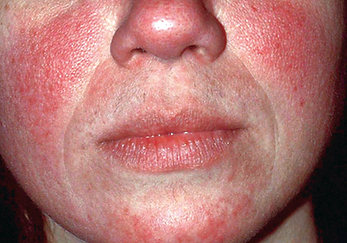 rosacea_f1.png