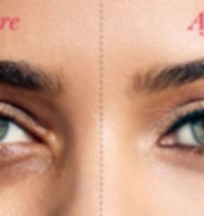 Dark Circles Under Eye