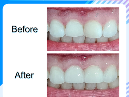 รีวิวอุดฟันแบบวีเนียร์