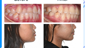 รีวิวจัดฟัน แก้ฟันซ้อน + แก้ฟันล่างคร่อมฟันบน