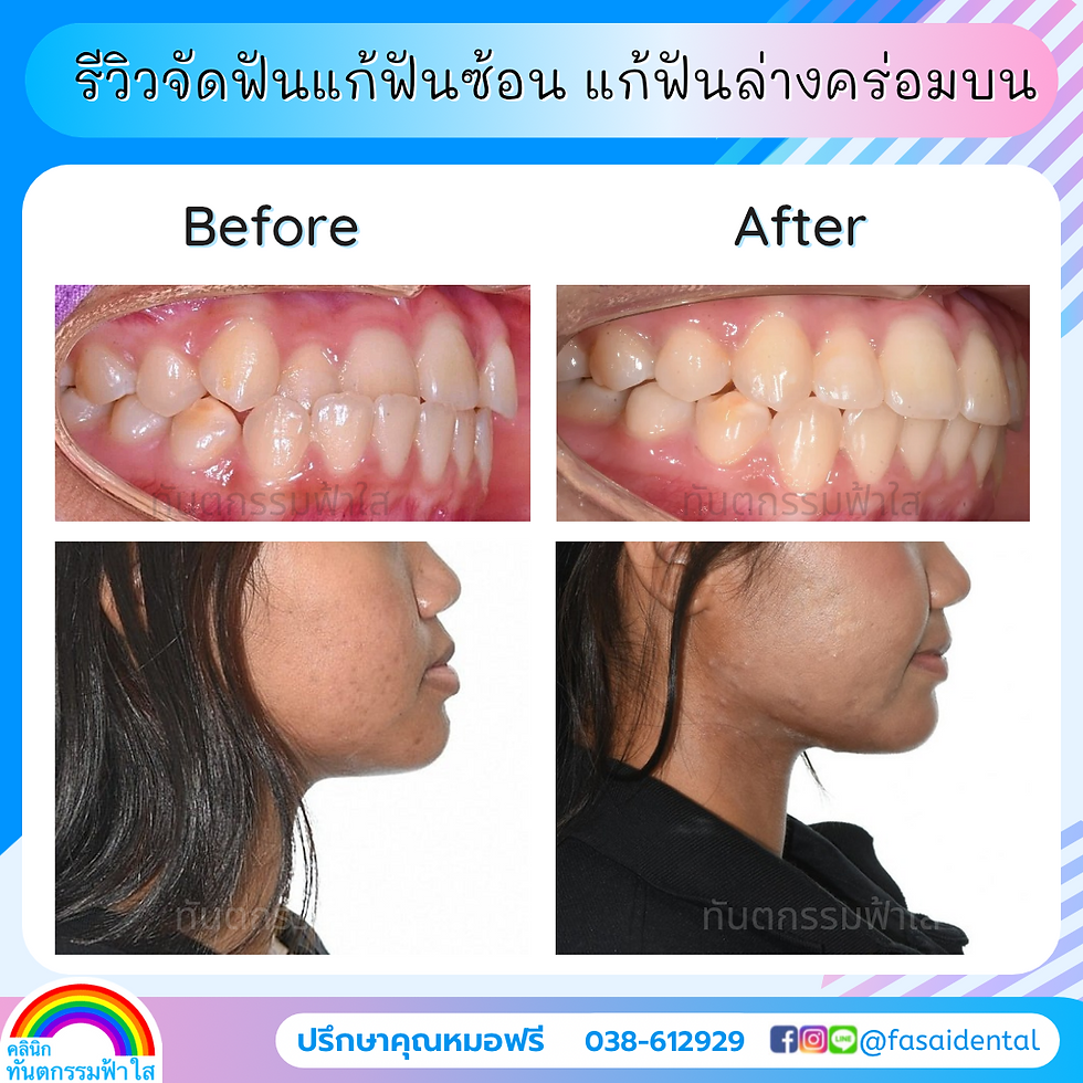 รีวิวจัดฟัน แก้ฟันซ้อน + แก้ฟันล่างคร่อมฟันบน