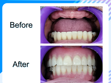 รีวิวใส่ฟันปลอม