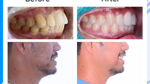 รีวิวจัดฟันแก้ฟันเหยิน