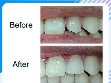 รีวิวอุดปิดช่องว่าง