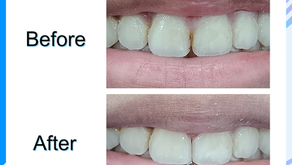 รีวิวอุดซอกฟันผุ