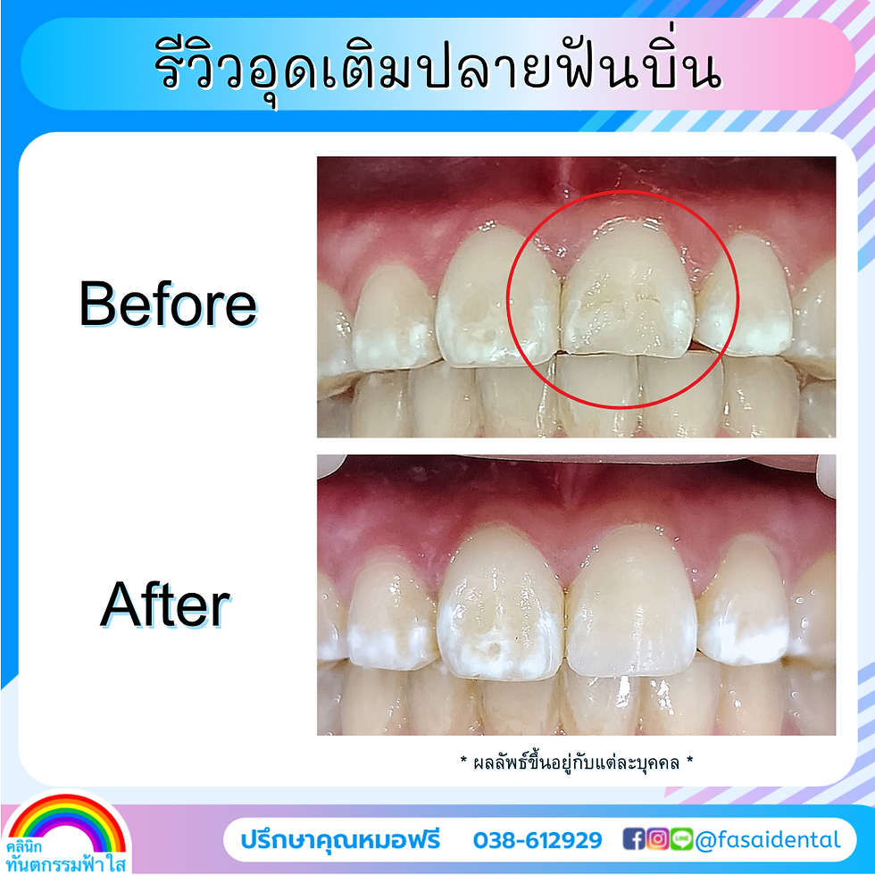 อุดเติมปลายฟันบิ่น