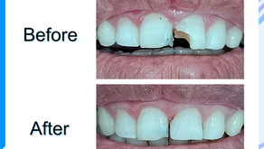 รีวิวอุดฟันหน้า