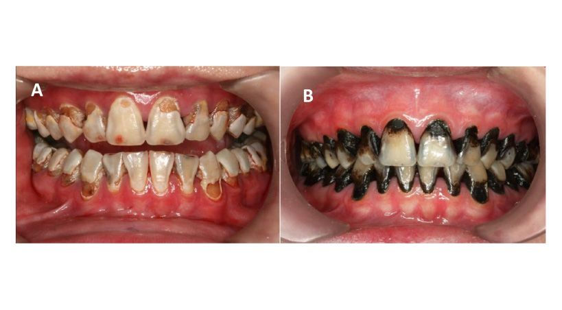 Uso de Nitrato de Plata