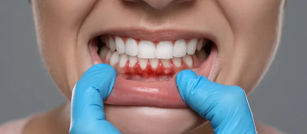 Gingivitis descamativa