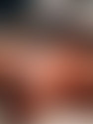 Αποθηλασμός