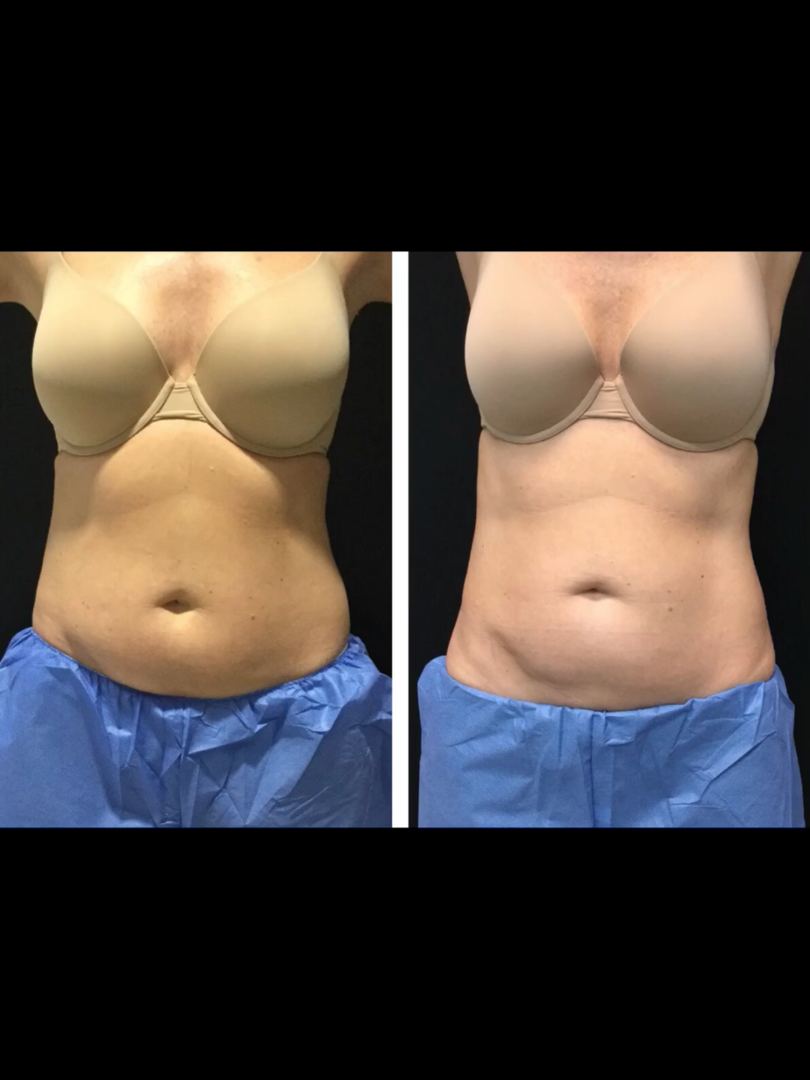 Best Non Invasive Body Fat Reduction Treatment SCULPT CYPRES