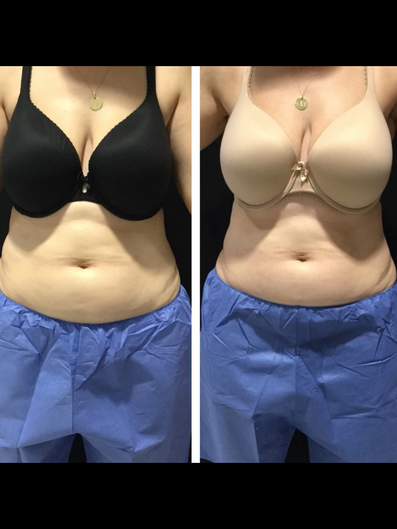 Best Non Invasive Body Fat Reduction Treatment SCULPT CYPRES